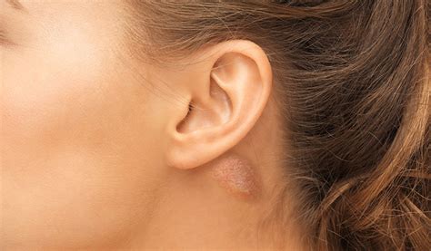 In order of likelihood, these conditions are infection. . Tinnitus and lump behind ear
